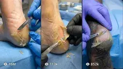 Dead skin removal and heel cleaning videos